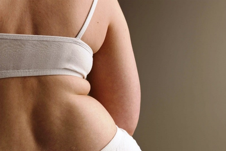 What Causes Upper Back Fat Accumulation?