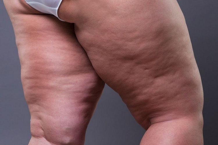 Leg fat and cellulite